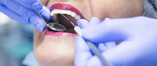 Best Emergency Dentist for Lost Fillings or Crowns in Bude, MS